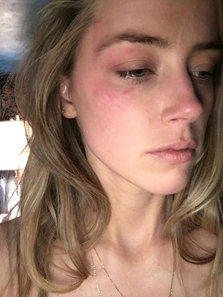 Amber Heard com olho roxo, supostamente após agressão de Johnny Depp