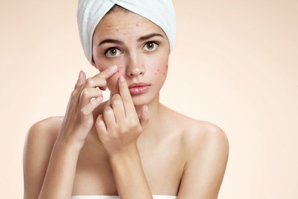  Saiba o que desencadeia acne na fase adulta