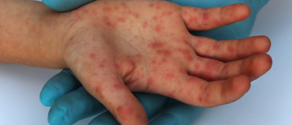 Uberlândia tem nove casos confirmados de sarampo