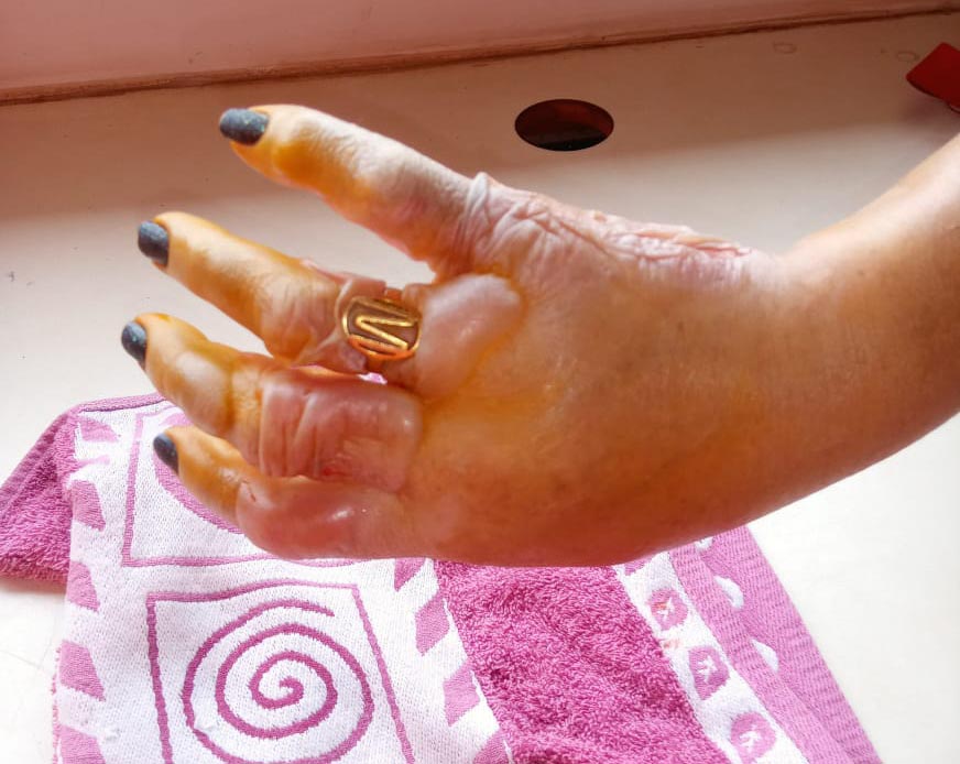 Ituiutaba: Mulher sofre queimadura na mão e anel estrangula dedo