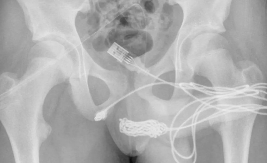 Garoto de 15 anos tenta medir pênis com cabo USB e objeto fica preso na uretra