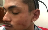 Agressões deixaram marcas no rosto de Salatiel Meneses, de 26 anos — Foto: Arquivo pessoal