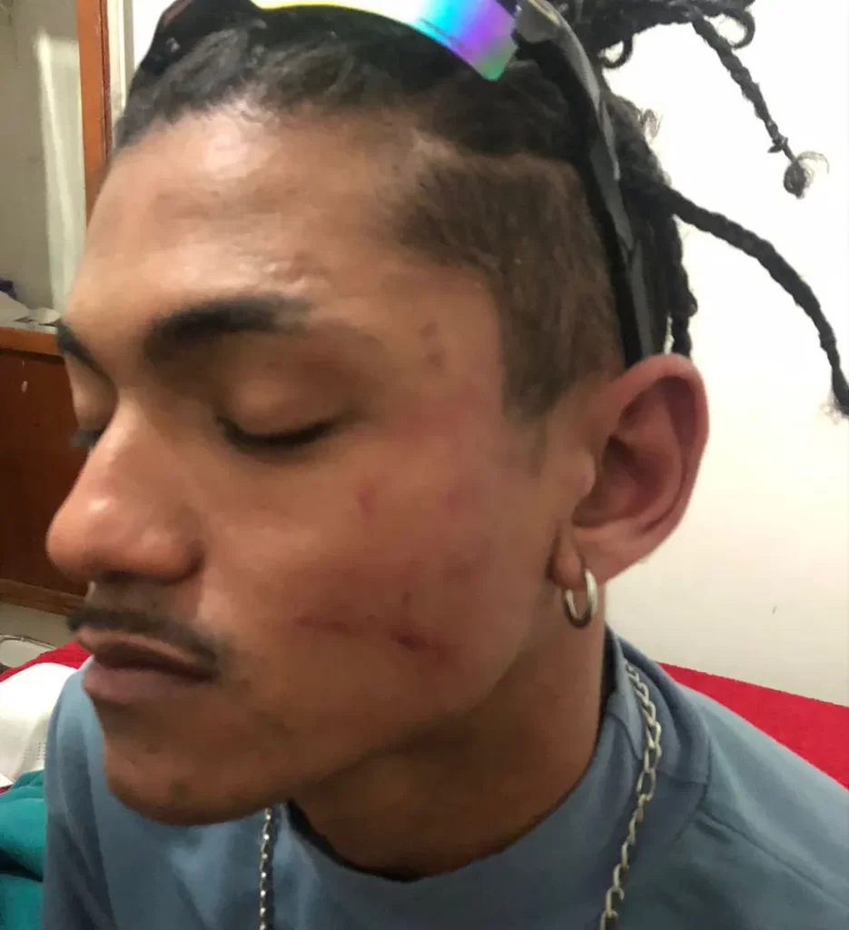 Agressões deixaram marcas no rosto de Salatiel Meneses, de 26 anos — Foto: Arquivo pessoal